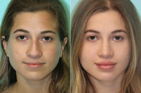 Before and after Lip Augmentation by Dr. Shervin Naderi, Patient 21613