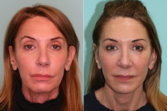 Before and after Facelift by Dr. Shervin Naderi, Patient 21726