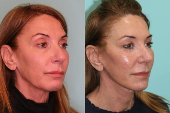 Before and after Facelift by Dr. Shervin Naderi, Patient 21726