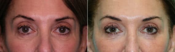 Before and after Blepharoplasty by Dr. Shervin Naderi, Patient 21727