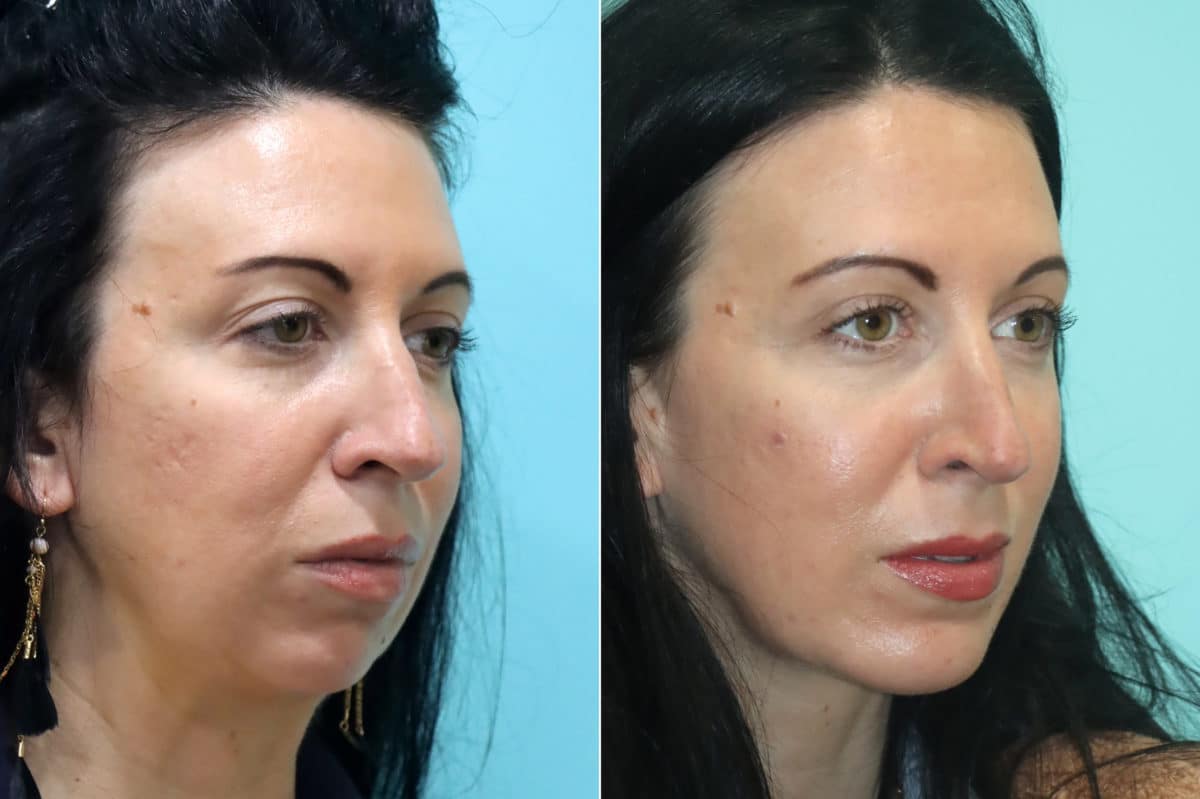 Before and after Chin & Facial Implant by Dr. Shervin Naderi, Patient 21777