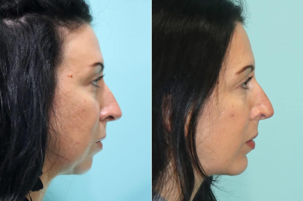 Before and after Chin & Facial Implant by Dr. Shervin Naderi, Patient 21777