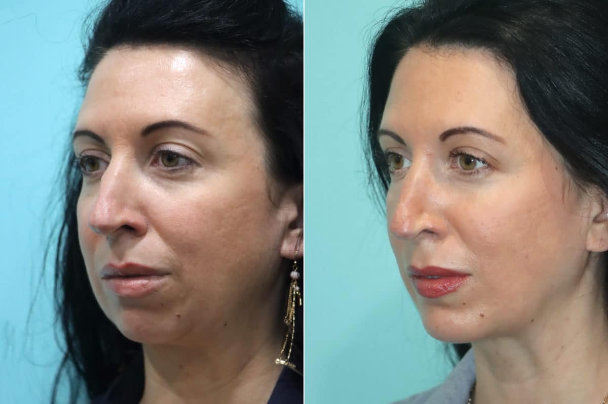 Before and after Chin & Facial Implant by Dr. Shervin Naderi, Patient 21777