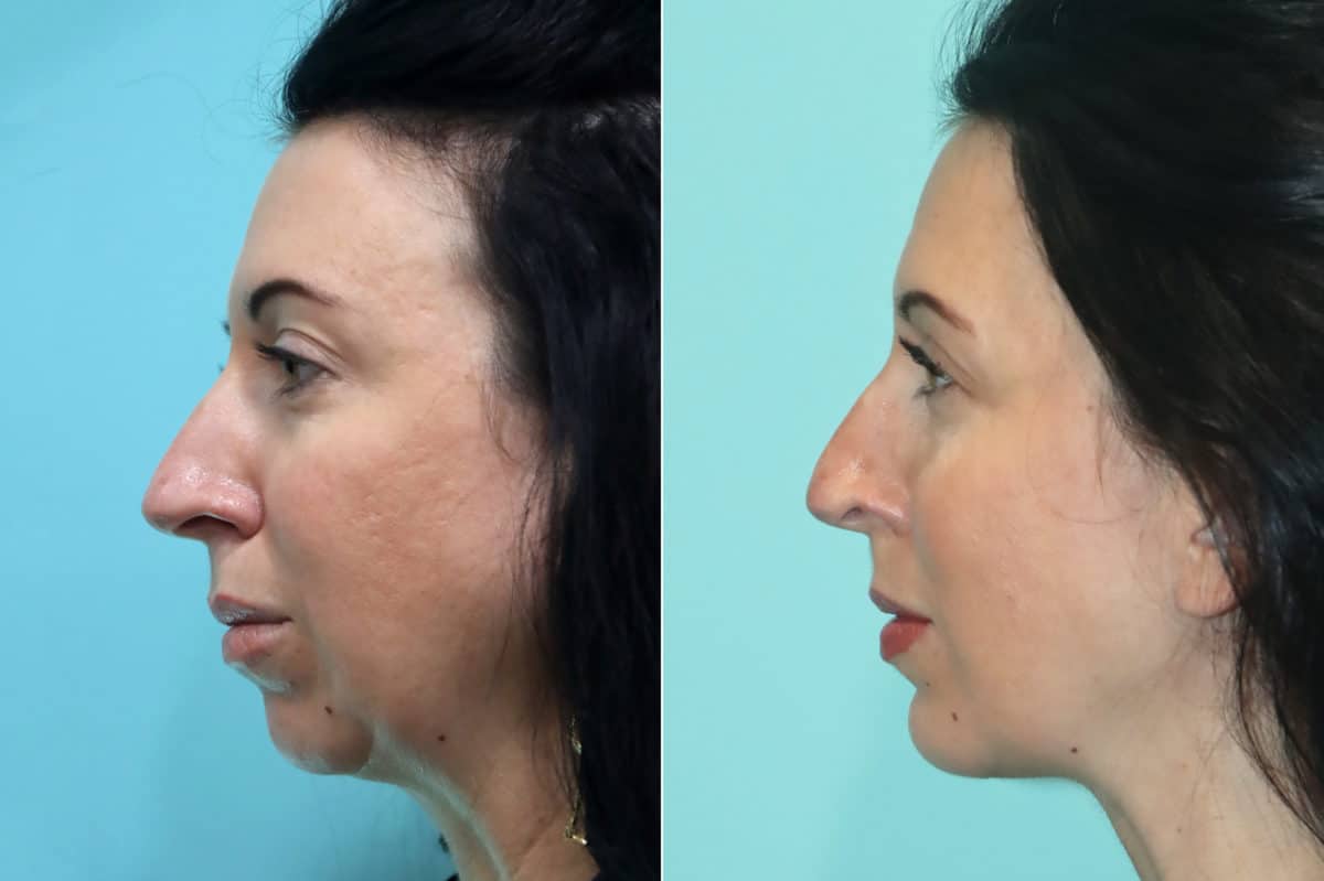 Before and after Chin & Facial Implant by Dr. Shervin Naderi, Patient 21777