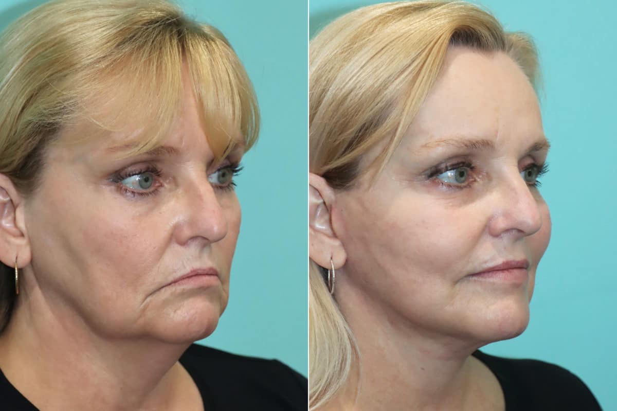 Before and after Facelift by Dr. Shervin Naderi, Patient 21366