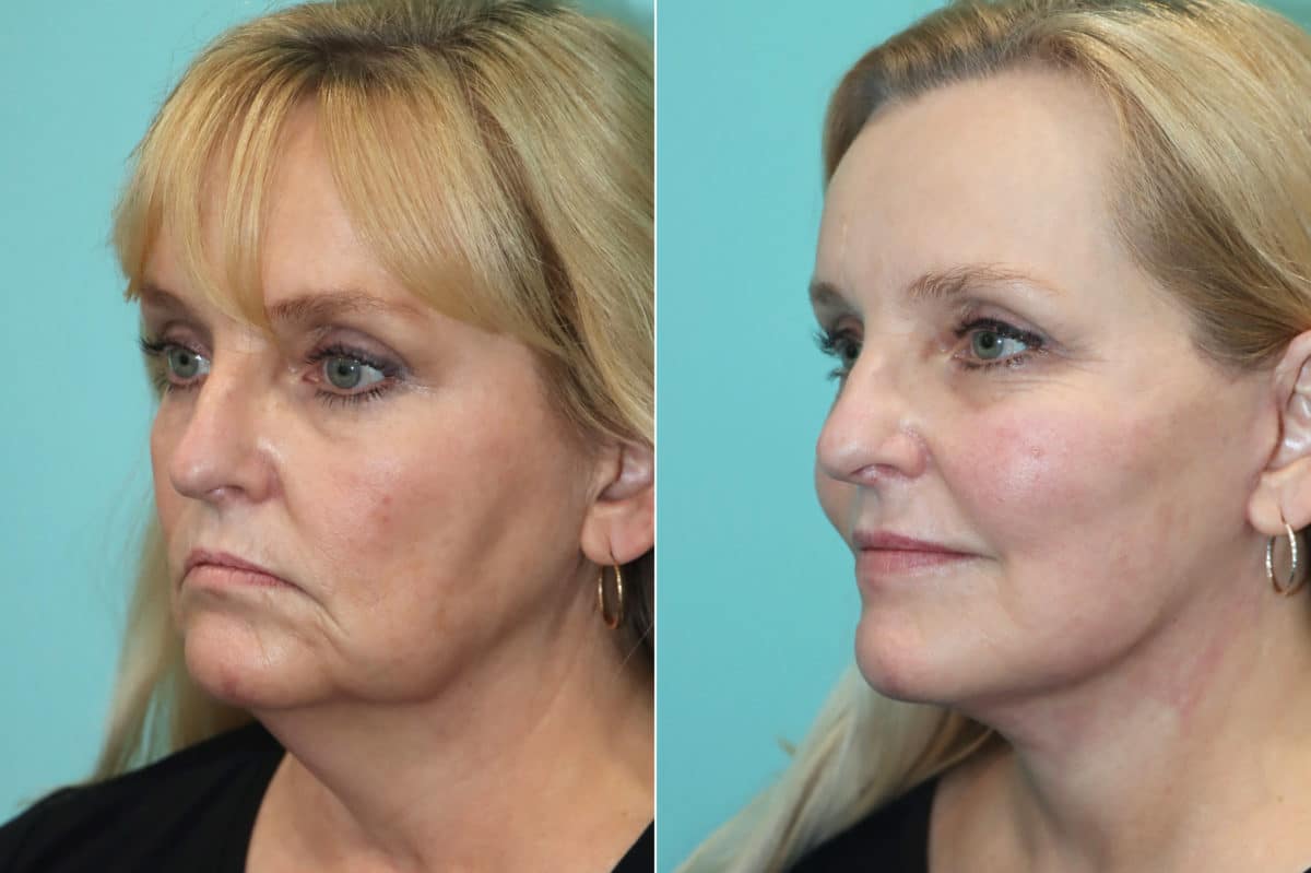 Before and after Facelift by Dr. Shervin Naderi, Patient 21366