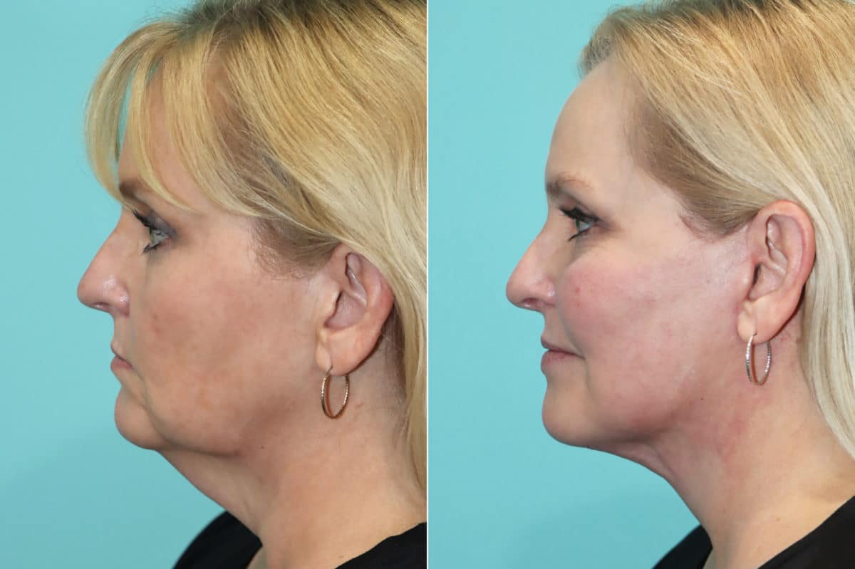 Before and after Facelift by Dr. Shervin Naderi, Patient 21366