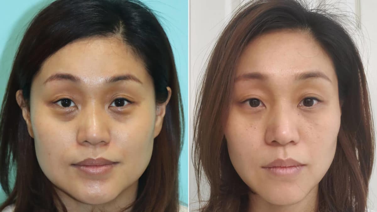 Before and after Botox Injections by Dr. Shervin Naderi, Patient 21990