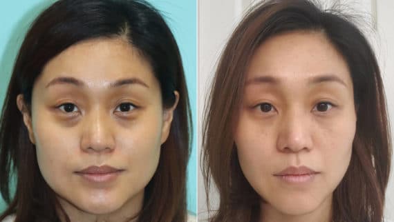 Before and after Botox Injections by Dr. Shervin Naderi, Patient 21990