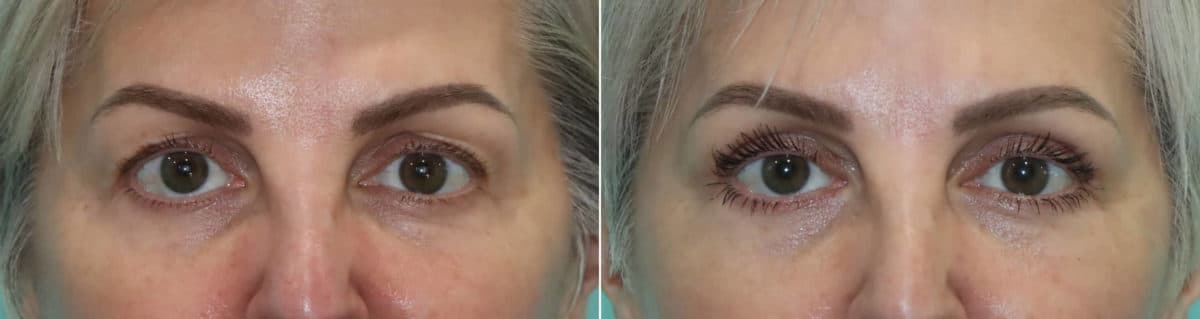 Before and after Blepharoplasty by Dr. Shervin Naderi, Patient 21998