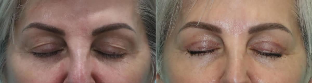 Before and after Blepharoplasty by Dr. Shervin Naderi, Patient 21998