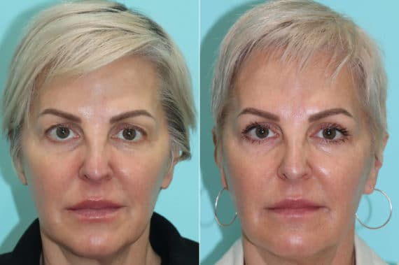 Before and after Blepharoplasty by Dr. Shervin Naderi, Patient 21998