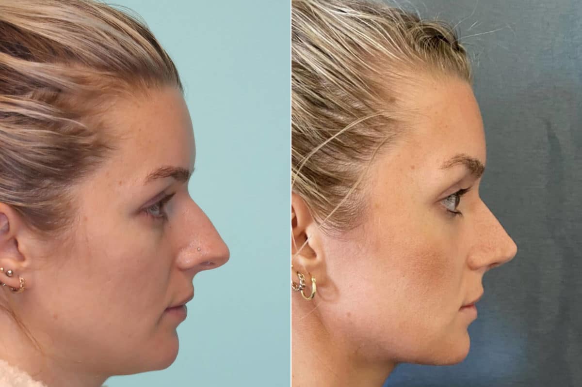 Before and after Rhinoplasty by Dr. Shervin Naderi, Patient 22012