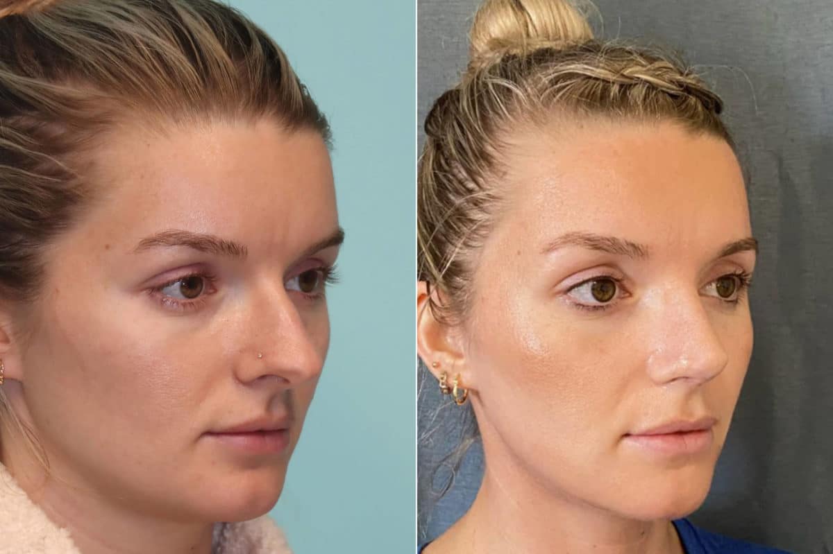 Before and after Rhinoplasty by Dr. Shervin Naderi, Patient 22012