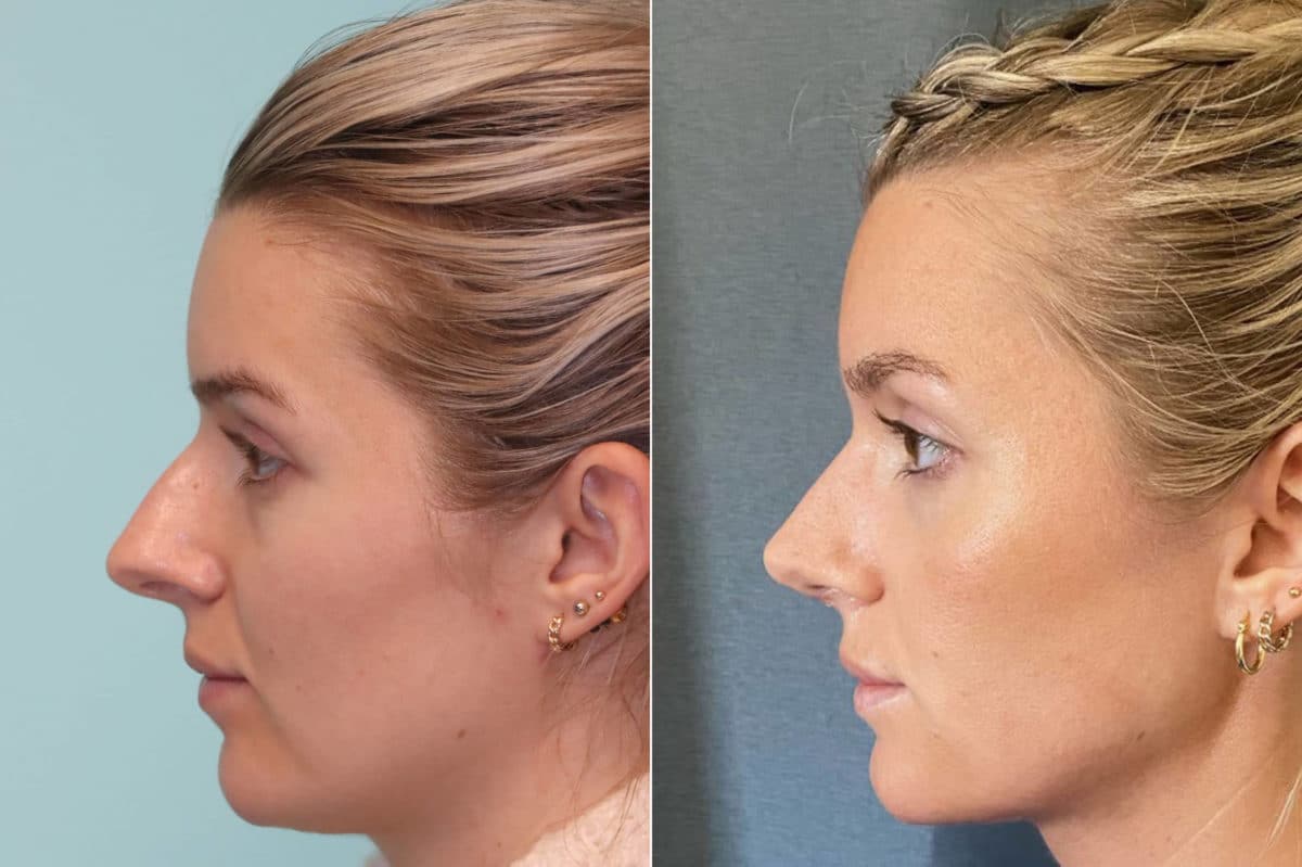 Before and after Rhinoplasty by Dr. Shervin Naderi, Patient 22012