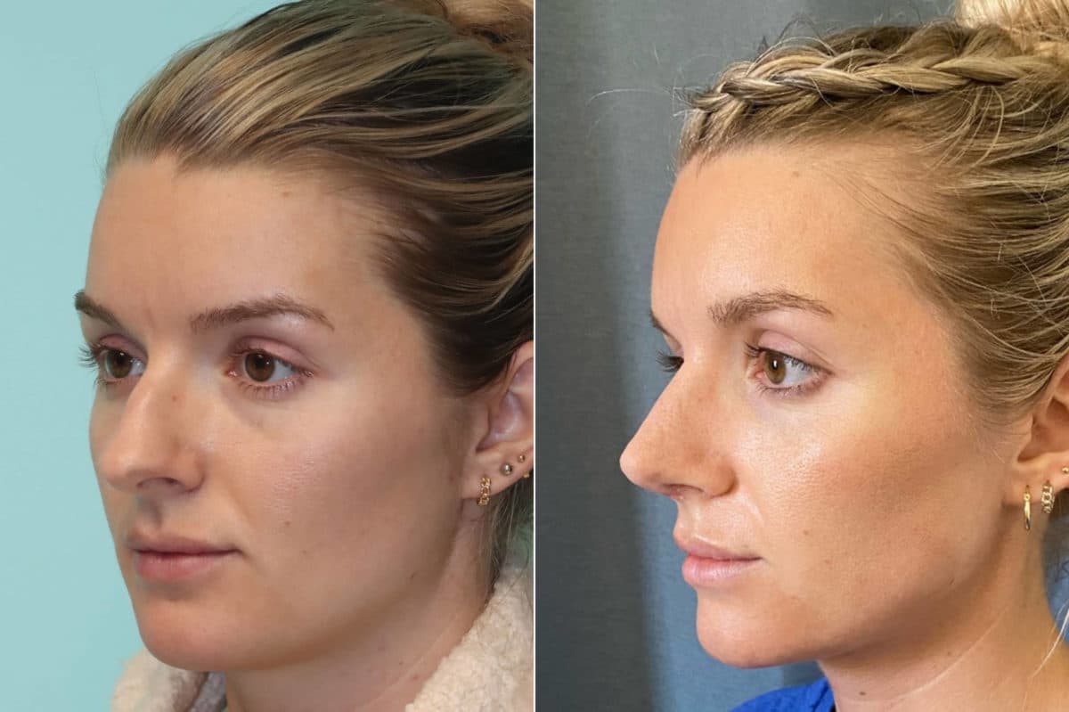 Before and after Rhinoplasty by Dr. Shervin Naderi, Patient 22012