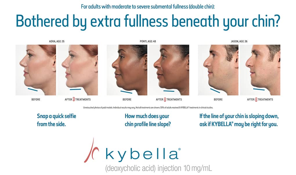 Kybella - Bothered by extra fullness beneath your chin?