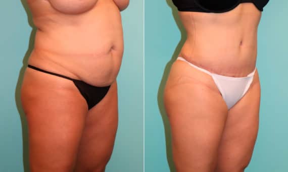 Before and after Tummy Tuck by Dr. Shervin Naderi, Patient 22096