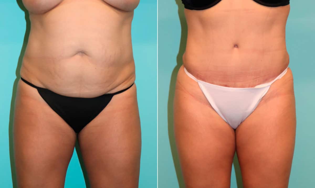 Before and after Tummy Tuck by Dr. Shervin Naderi, Patient 22096