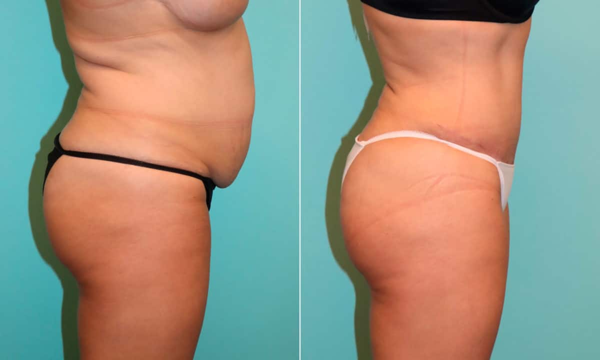 Before and after Tummy Tuck by Dr. Shervin Naderi, Patient 22096