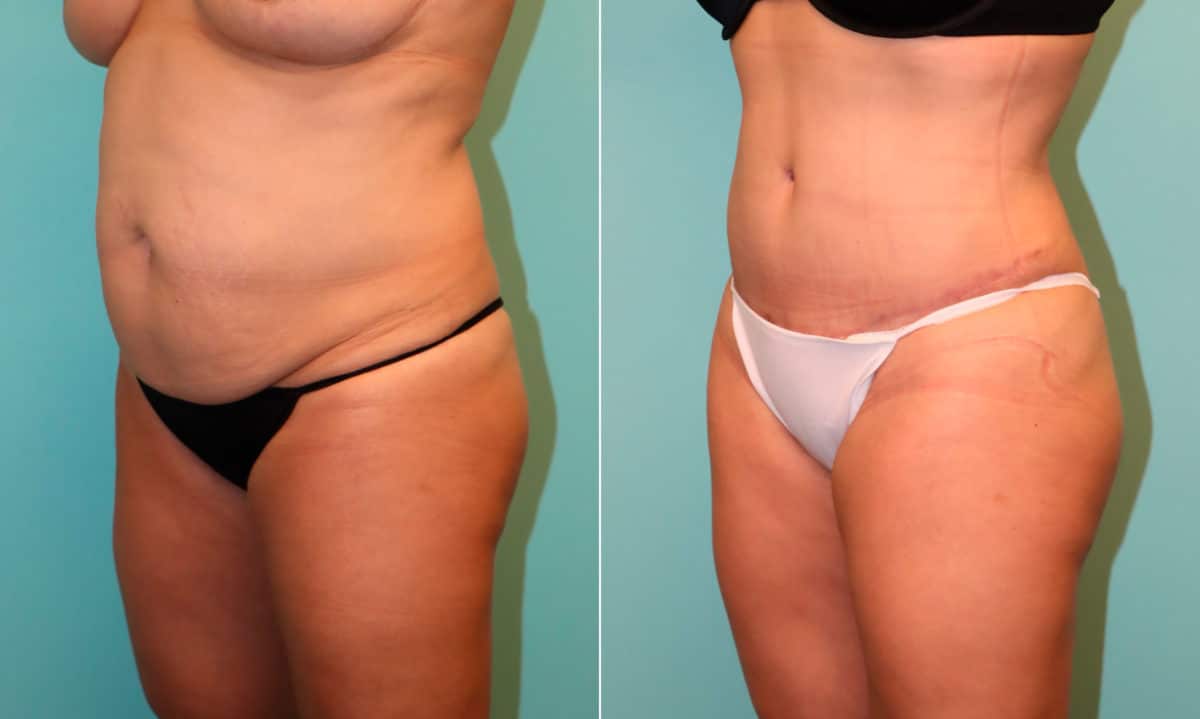 Before and after Tummy Tuck by Dr. Shervin Naderi, Patient 22096