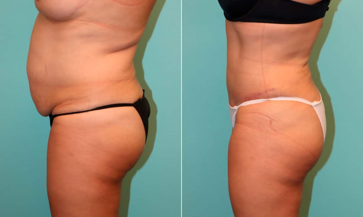 Before and after Tummy Tuck by Dr. Shervin Naderi, Patient 22096