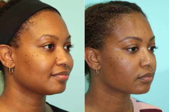 Before and after KYBELLA by Dr. Shervin Naderi, Patient 22112