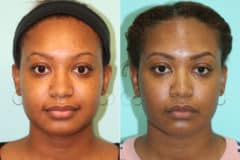 Before and after KYBELLA by Dr. Shervin Naderi, Patient 22112