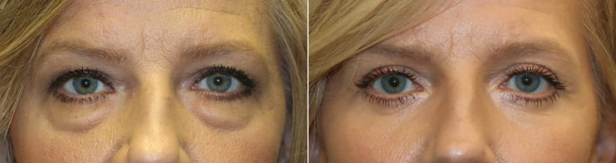 Before and after Blepharoplasty by Dr. Shervin Naderi, Patient 22162