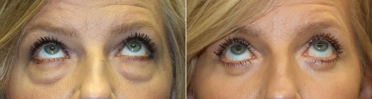 Before and after Blepharoplasty by Dr. Shervin Naderi, Patient 22162