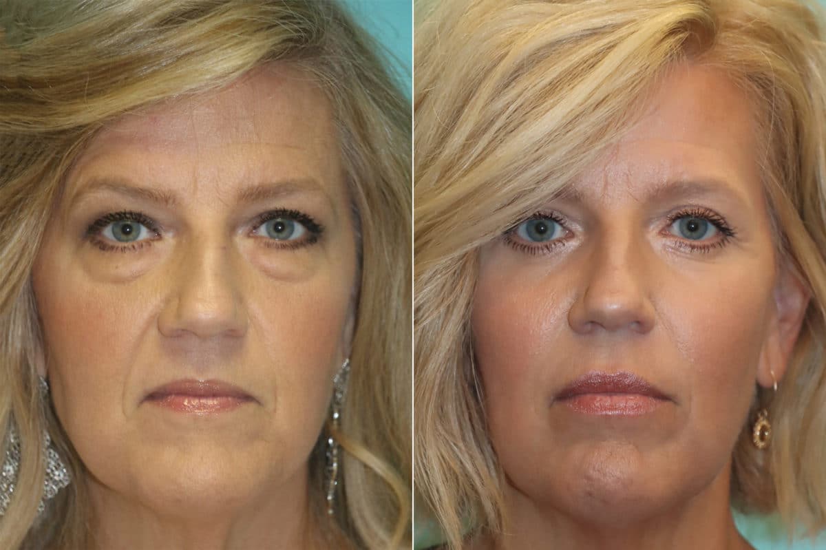 Before and after Blepharoplasty by Dr. Shervin Naderi, Patient 22162