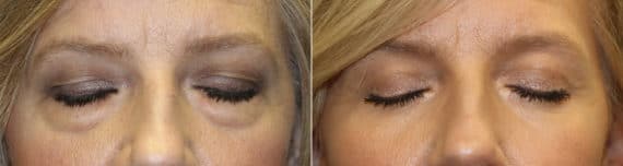 Before and after Blepharoplasty by Dr. Shervin Naderi, Patient 22162