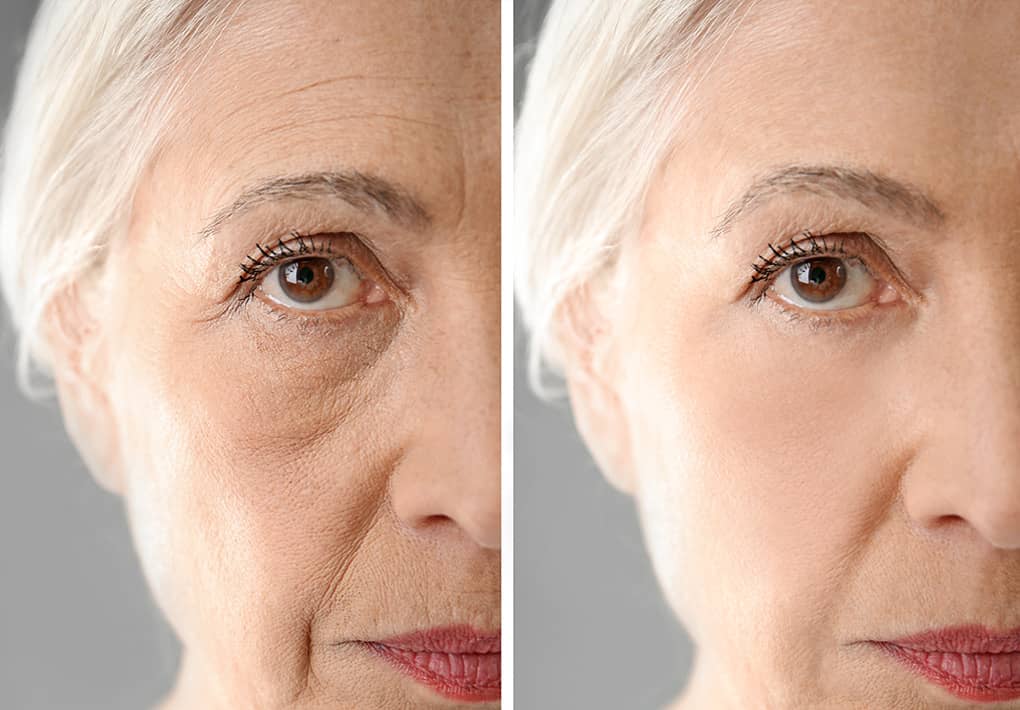 Sunken flat cheeks occur with aging and can be improved with hyaluronic acid fillers