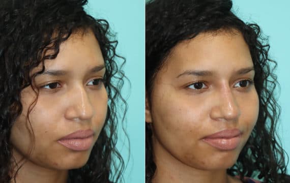 Before and after Non-Surgical Rhinoplasty by Dr. Shervin Naderi, Patient 22391