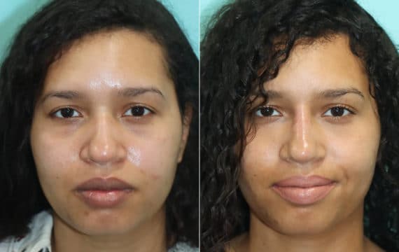 Before and after Non-Surgical Rhinoplasty by Dr. Shervin Naderi, Patient 22391