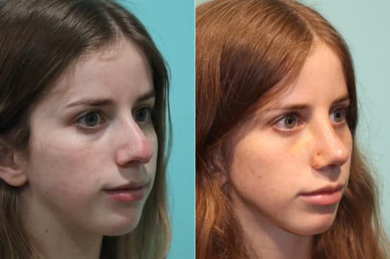 Before and after Rhinoplasty by Dr. Shervin Naderi, Patient 22409