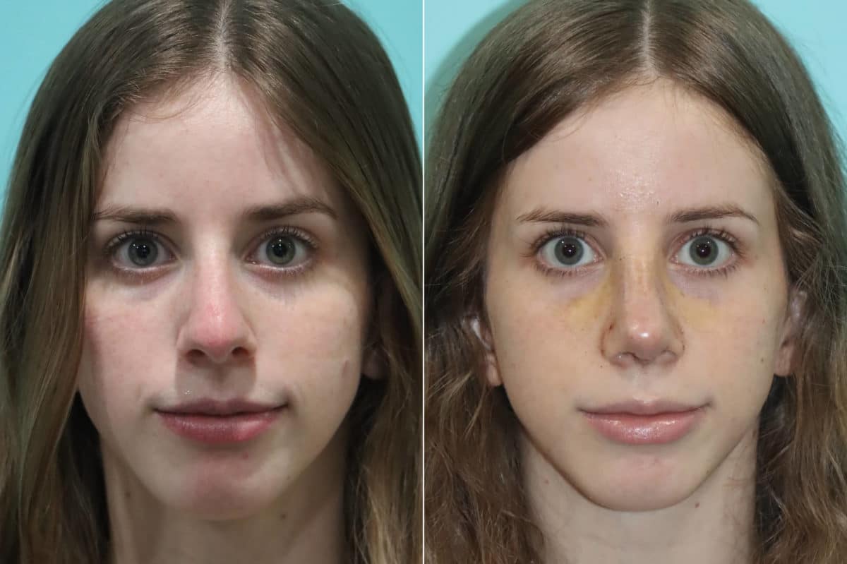 Before and after Rhinoplasty by Dr. Shervin Naderi, Patient 22409