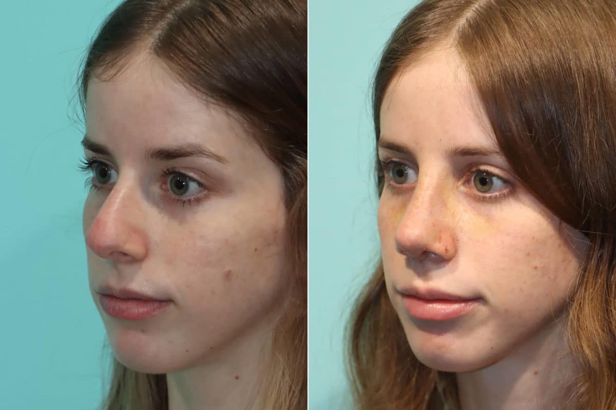 Before and after Rhinoplasty by Dr. Shervin Naderi, Patient 22409