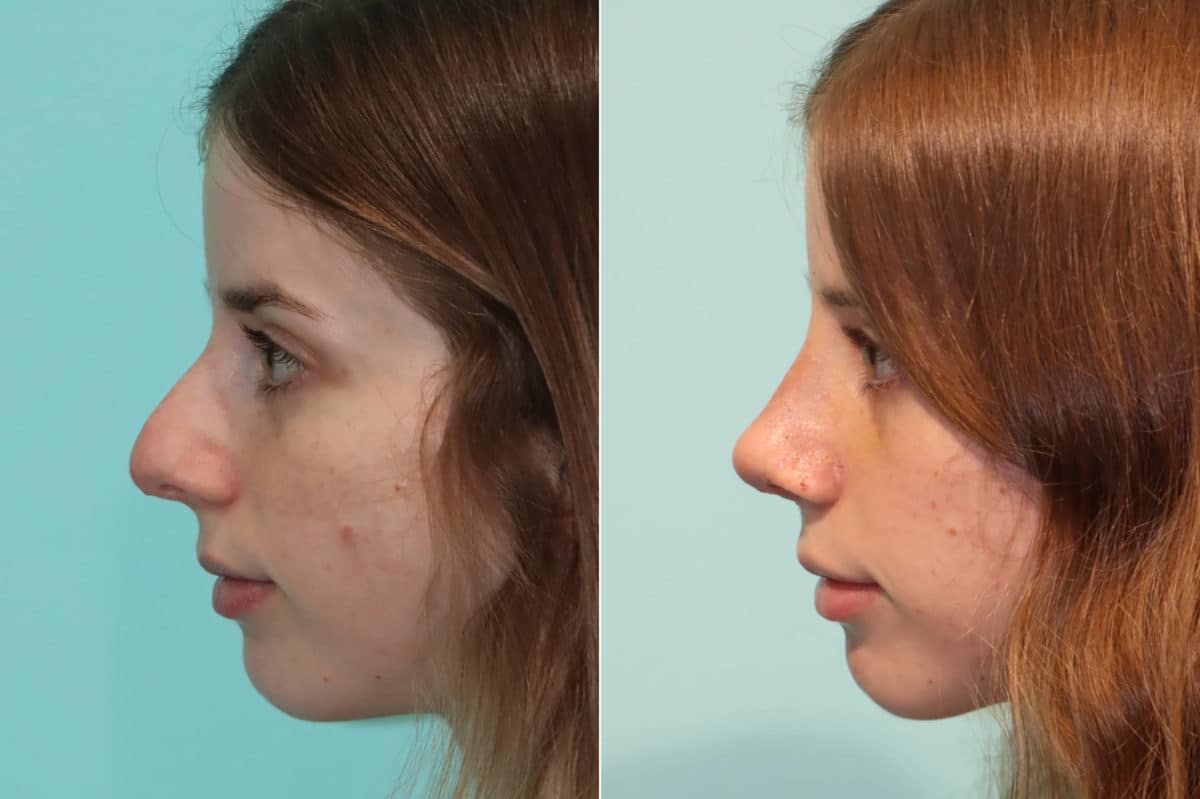 Before and after Rhinoplasty by Dr. Shervin Naderi, Patient 22409