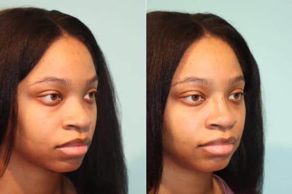 Before and after Non-Surgical Rhinoplasty by Dr. Shervin Naderi, Patient 22446