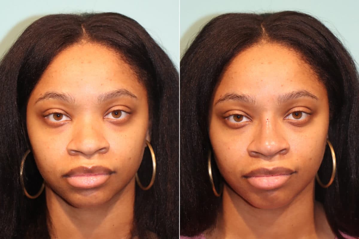 Before and after Non-Surgical Rhinoplasty by Dr. Shervin Naderi, Patient 22446