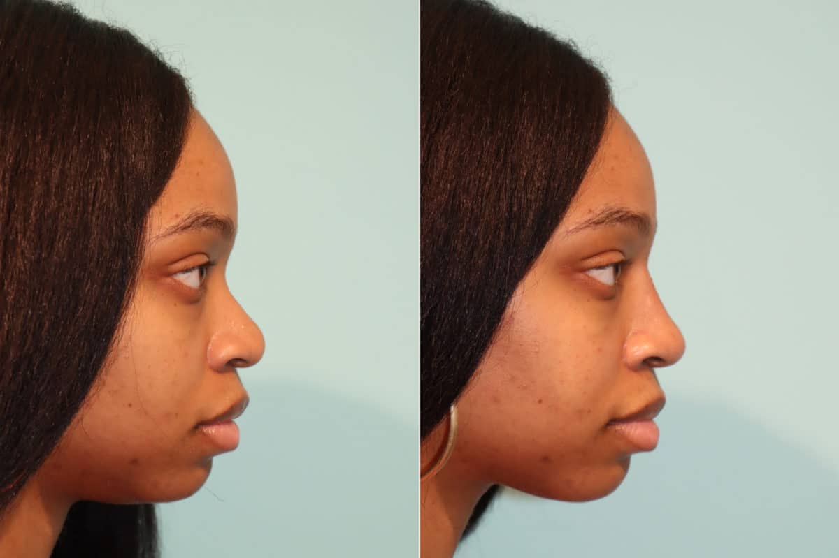 Before and after Non-Surgical Rhinoplasty by Dr. Shervin Naderi, Patient 22446