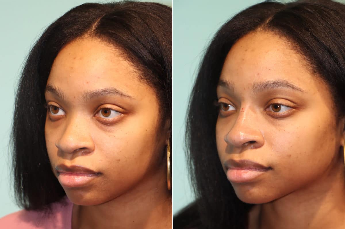 Before and after Non-Surgical Rhinoplasty by Dr. Shervin Naderi, Patient 22446