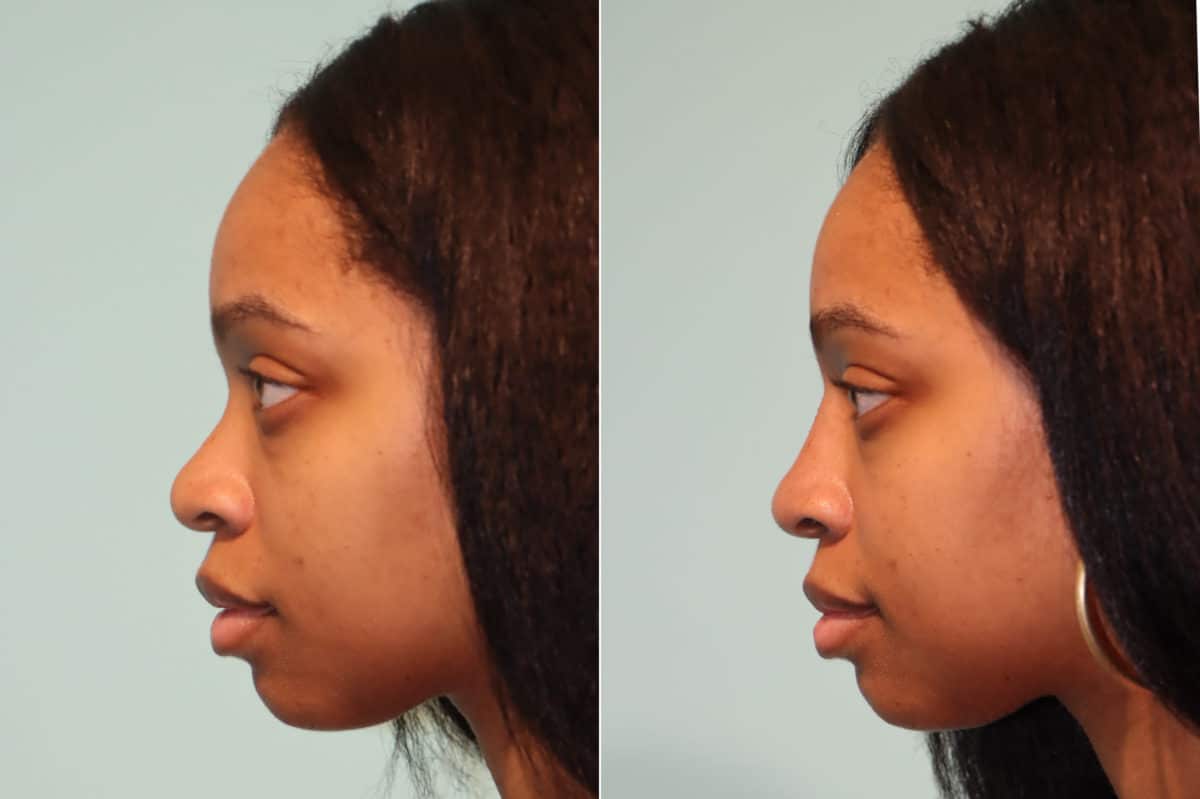 Before and after Non-Surgical Rhinoplasty by Dr. Shervin Naderi, Patient 22446