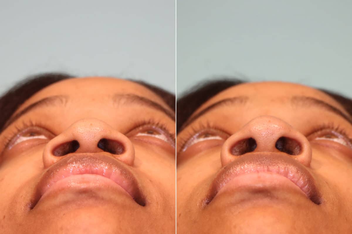 Before and after Non-Surgical Rhinoplasty by Dr. Shervin Naderi, Patient 22446