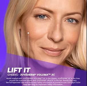 After Juvederm Injections, Liquid facelift: this procedure involves a combination of injected areas to lift the face, plump where volume has been lost and create an overall more youthful and rejuvenated appearance