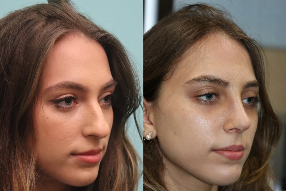 Before and after Rhinoplasty by Dr. Shervin Naderi, Patient 22470