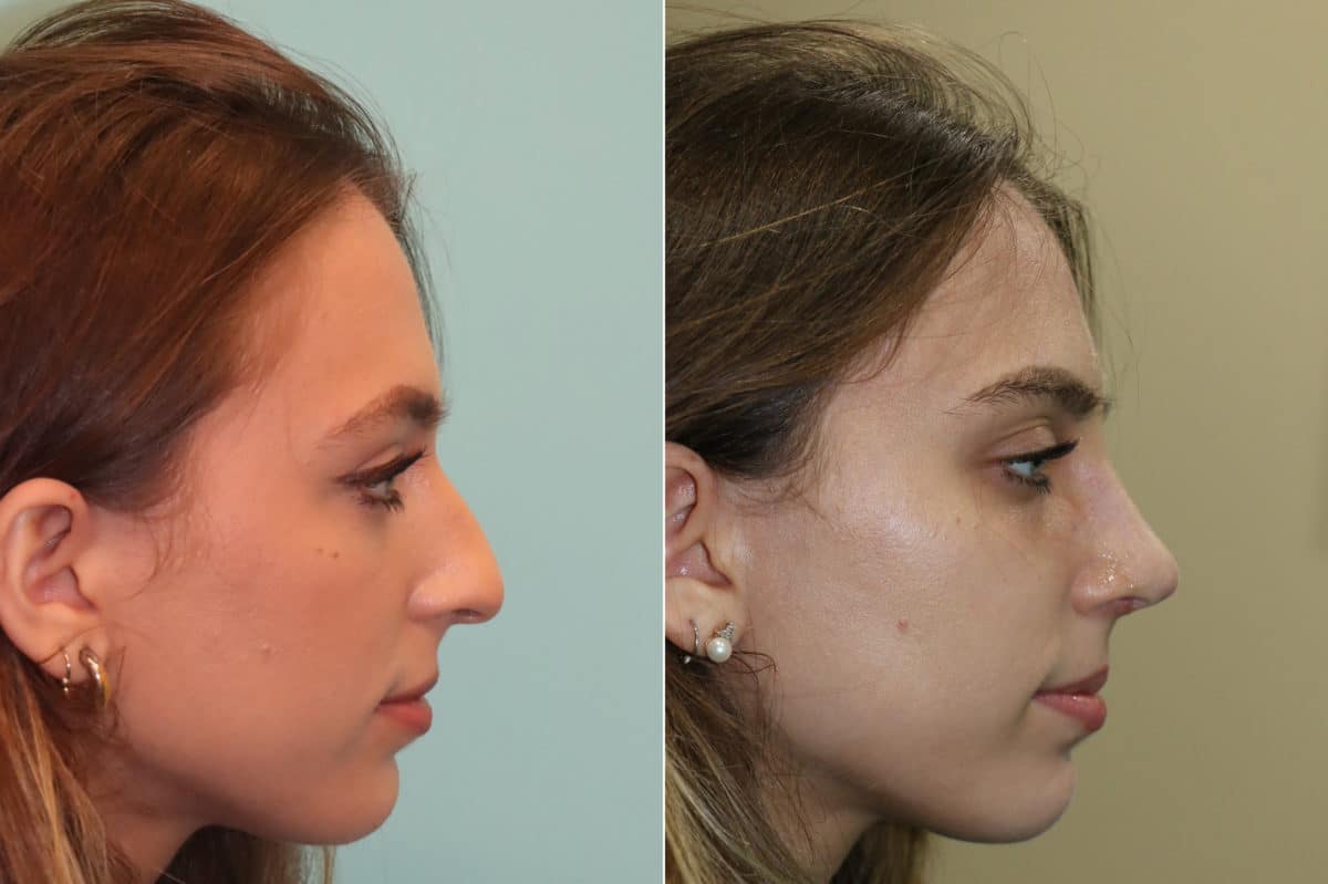 Before and after Rhinoplasty by Dr. Shervin Naderi, Patient 22470