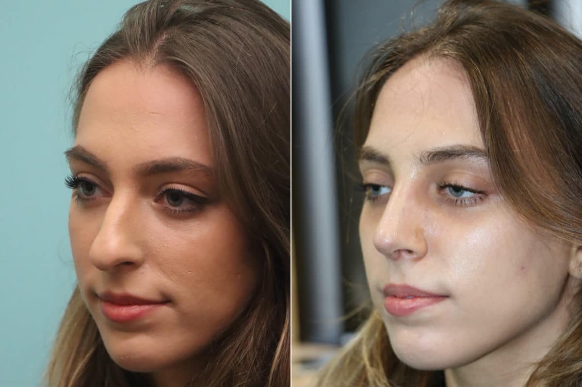 Before and after Rhinoplasty by Dr. Shervin Naderi, Patient 22470