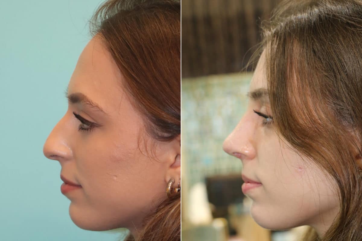 Before and after Rhinoplasty by Dr. Shervin Naderi, Patient 22470